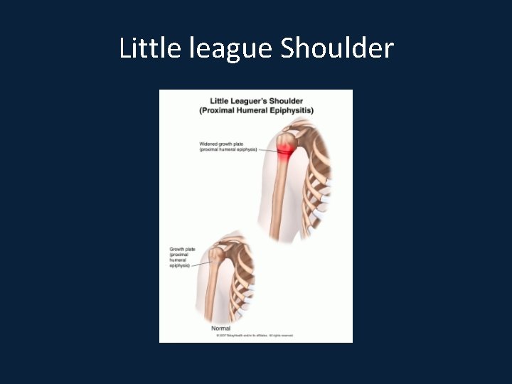 Little league Shoulder 