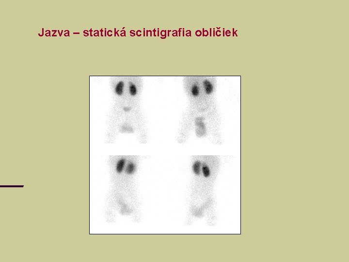 Jazva – statická scintigrafia obličiek 