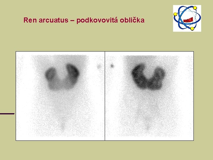 Ren arcuatus – podkovovitá oblička Ren arcuatus – podkovovitá oblička