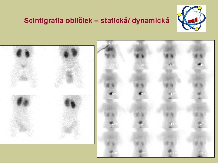 Scintigrafia obličiek – statická/ dynamická 