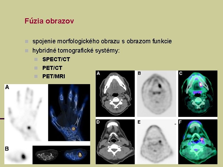 Fúzia obrazov spojenie morfologického obrazu s obrazom funkcie hybridné tomografické systémy: SPECT/CT PET/MRI Fúzia obrazov spojenie morfologického obrazu s obrazom funkcie hybridné tomografické systémy: SPECT/CT PET/MRI