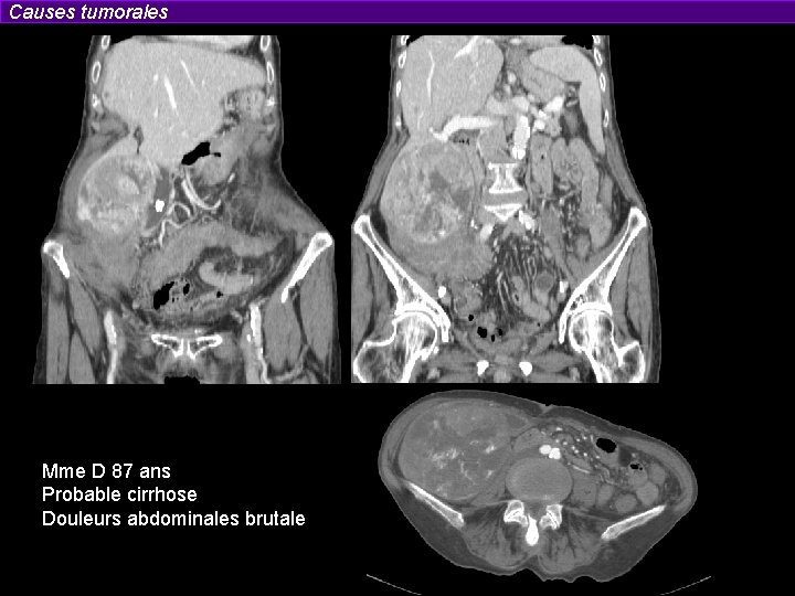 Causes tumorales Mme D 87 ans Probable cirrhose Douleurs abdominales brutale 