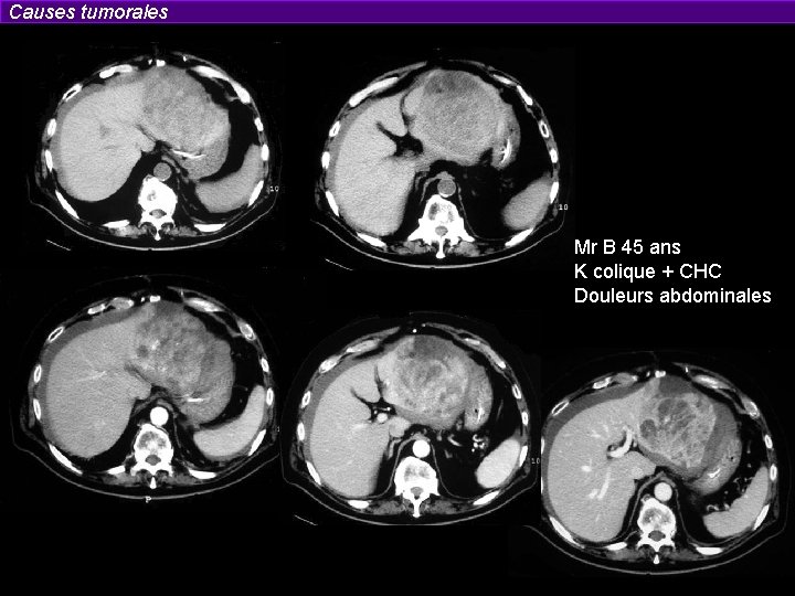 Causes tumorales Mr B 45 ans K colique + CHC Douleurs abdominales 