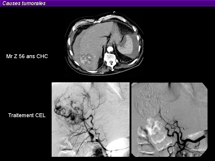 Causes tumorales Mr Z 56 ans CHC Traitement CEL 