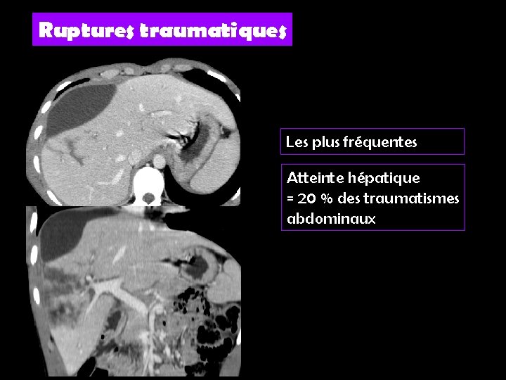 Ruptures traumatiques Les plus fréquentes Atteinte hépatique = 20 % des traumatismes abdominaux 