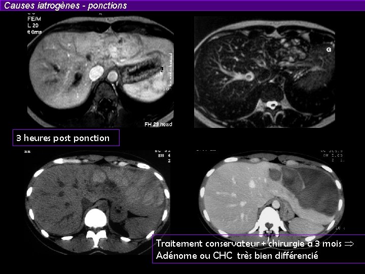 Causes iatrogènes - ponctions 3 heures post ponction Traitement conservateur + chirurgie à 3