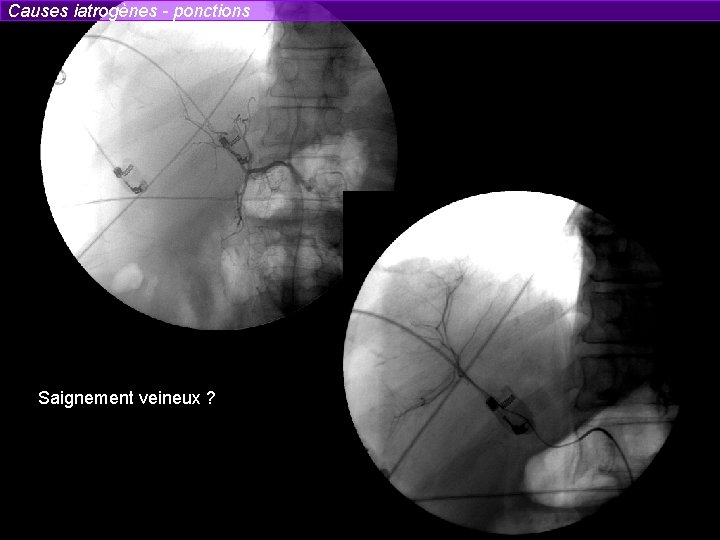 Causes iatrogènes - ponctions Saignement veineux ? 