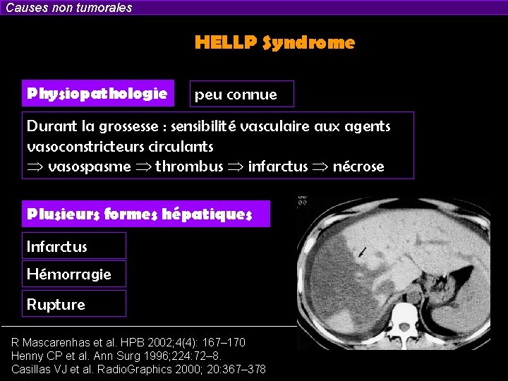 Causes non tumorales HELLP Syndrome Physiopathologie peu connue Durant la grossesse : sensibilité vasculaire