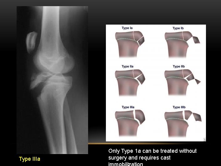 Type IIIa Only Type 1 a can be treated without surgery and requires cast