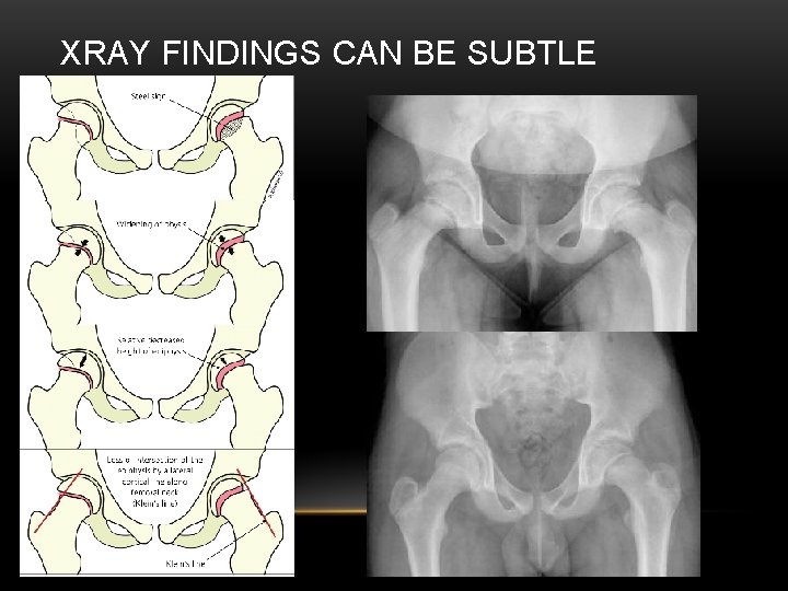 XRAY FINDINGS CAN BE SUBTLE 