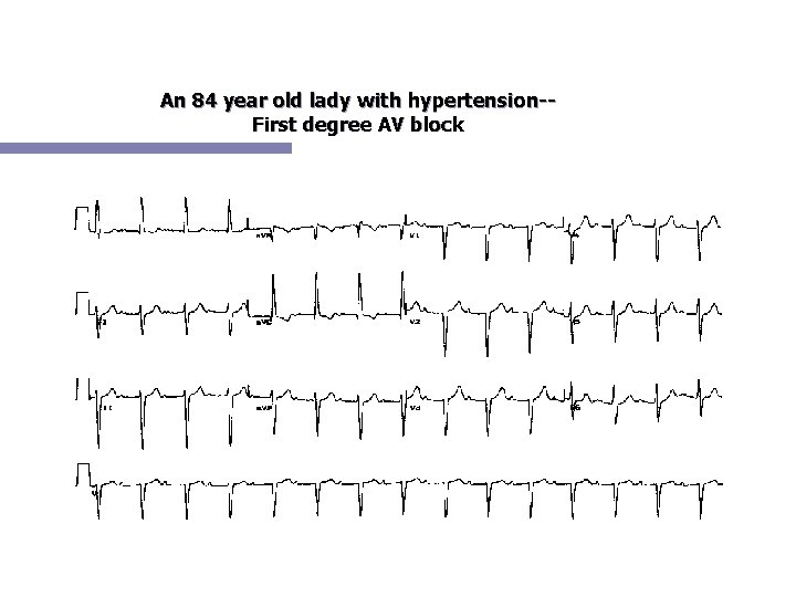 An 84 year old lady with hypertension-First degree AV block 