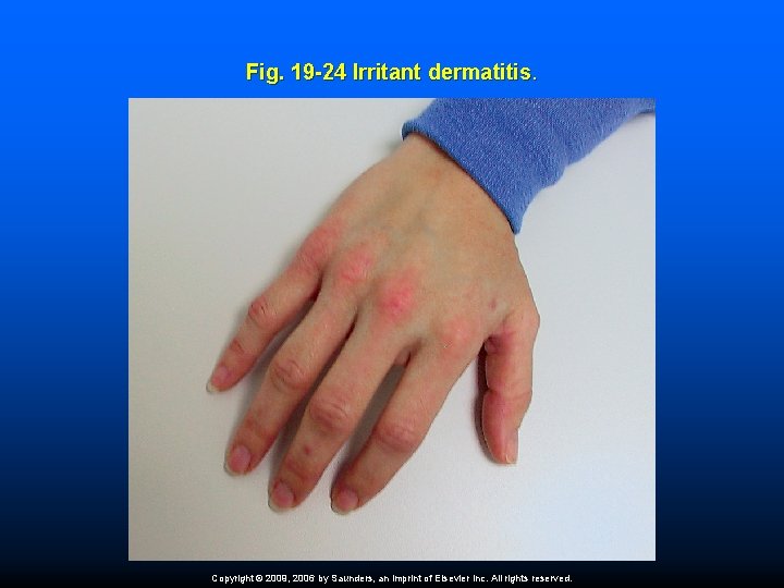 Fig. 19 -24 Irritant dermatitis. Copyright © 2009, 2006 by Saunders, an imprint of