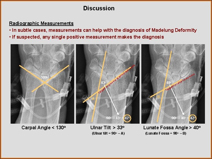 Discussion Radiographic Measurements • In subtle cases, measurements can help with the diagnosis of