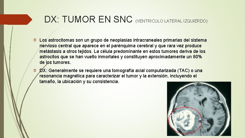 DX: TUMOR EN SNC (VENTRICULO LATERAL IZQUIERDO) Los astrocitomas son un grupo de neoplasias