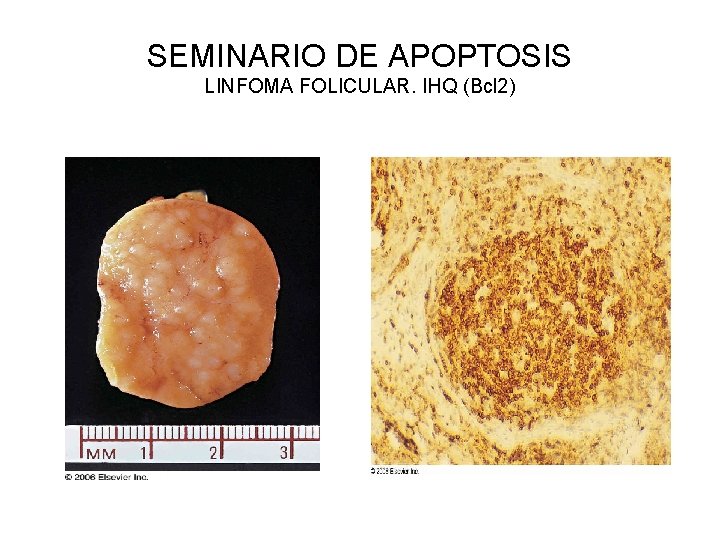 SEMINARIO DE APOPTOSIS LINFOMA FOLICULAR. IHQ (Bcl 2) 