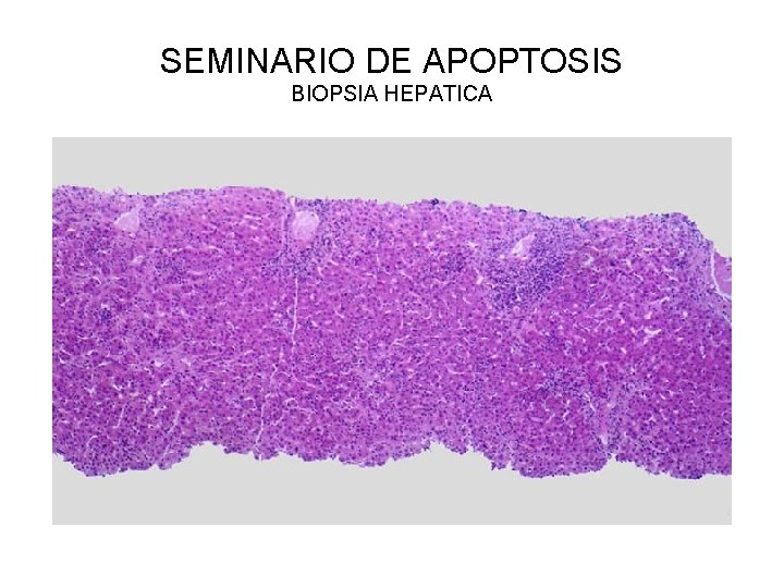 SEMINARIO DE APOPTOSIS BIOPSIA HEPATICA 