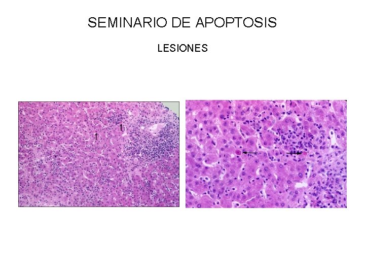 SEMINARIO DE APOPTOSIS LESIONES 