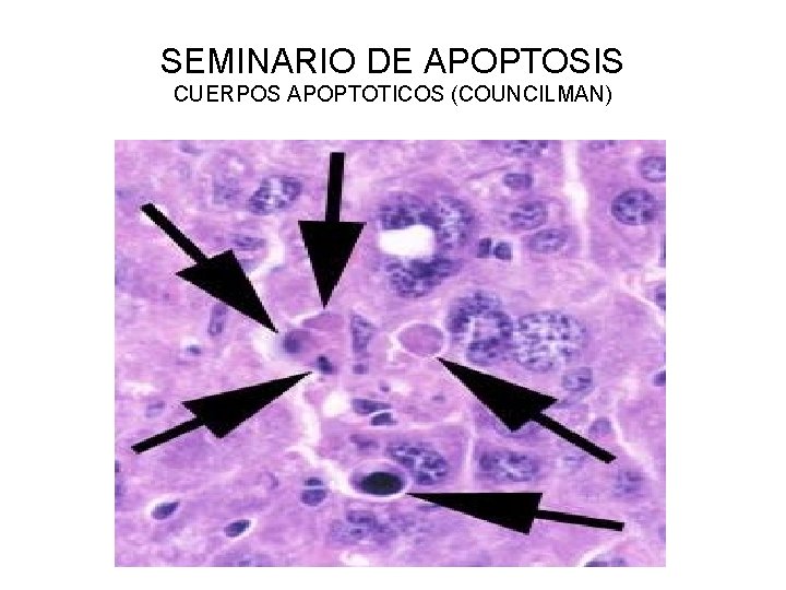 SEMINARIO DE APOPTOSIS CUERPOS APOPTOTICOS (COUNCILMAN) 