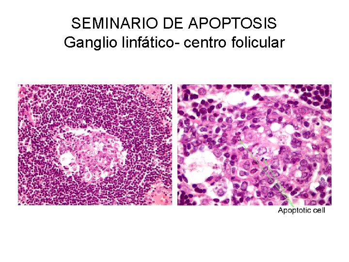 SEMINARIO DE APOPTOSIS Ganglio linfático- centro folicular 