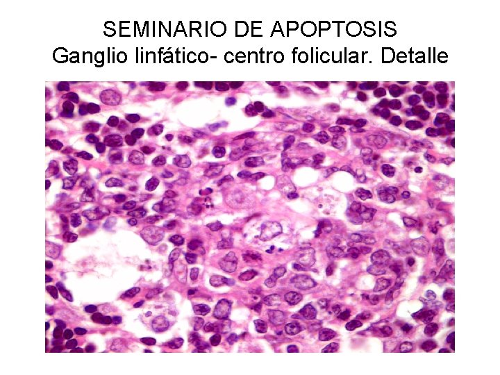 SEMINARIO DE APOPTOSIS Ganglio linfático- centro folicular. Detalle 