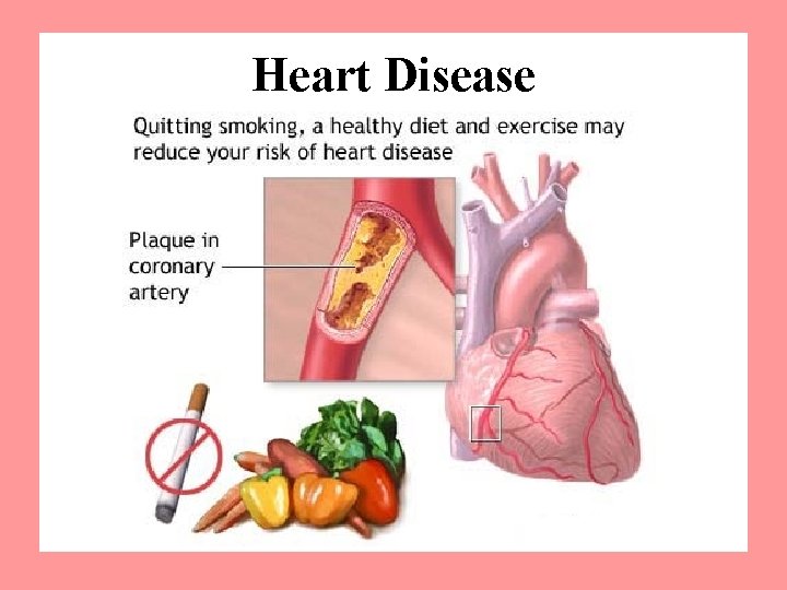 Heart Disease 