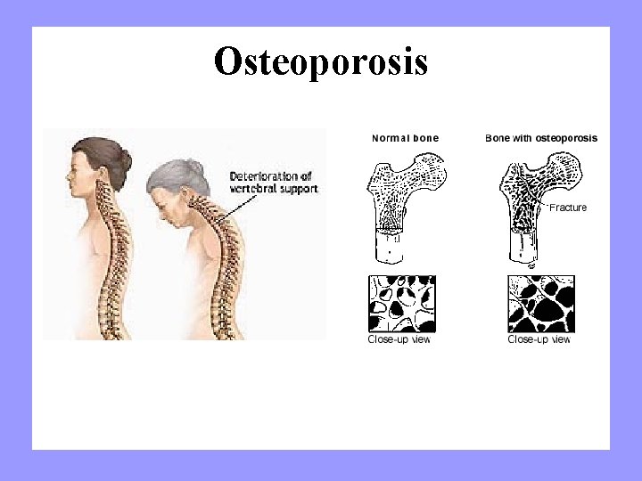 Osteoporosis 