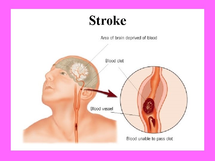 Stroke 