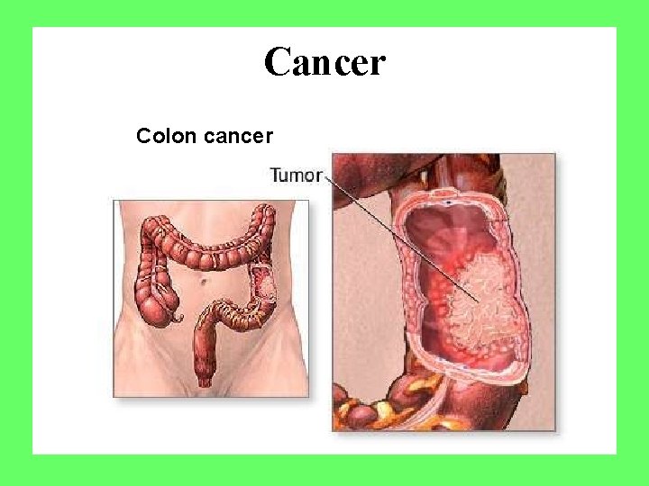Cancer Colon cancer 