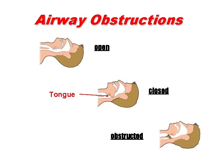 Airway Obstructions open closed Tongue obstructed 