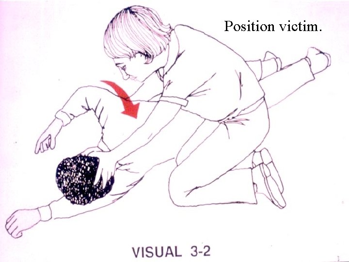 Position victim. 