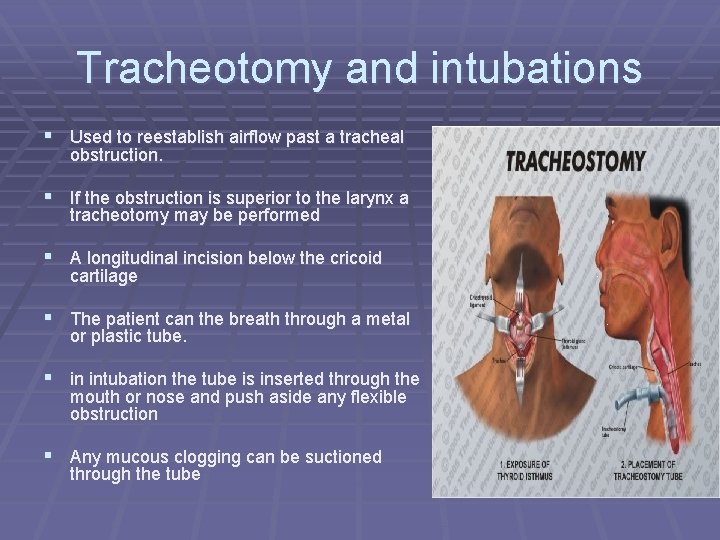 Tracheotomy and intubations § Used to reestablish airflow past a tracheal obstruction. § If