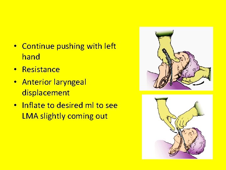  • Continue pushing with left hand • Resistance • Anterior laryngeal displacement •