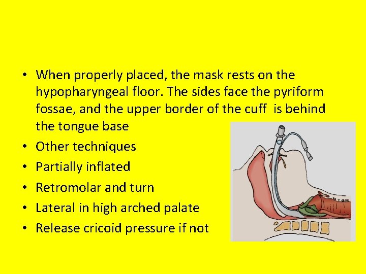  • When properly placed, the mask rests on the hypopharyngeal floor. The sides