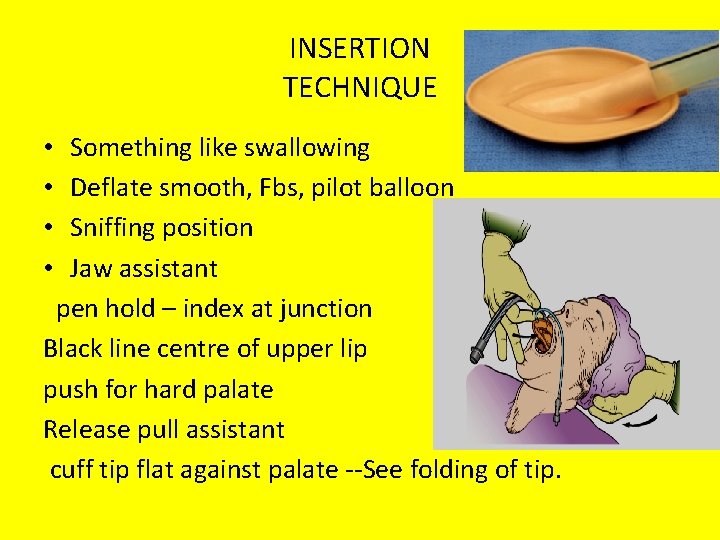 INSERTION TECHNIQUE Something like swallowing Deflate smooth, Fbs, pilot balloon Sniffing position Jaw assistant