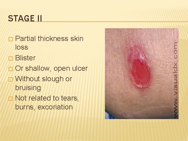 STAGE II Partial thickness skin loss � Blister � Or shallow, open ulcer �