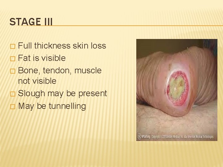 STAGE III Full thickness skin loss � Fat is visible � Bone, tendon, muscle