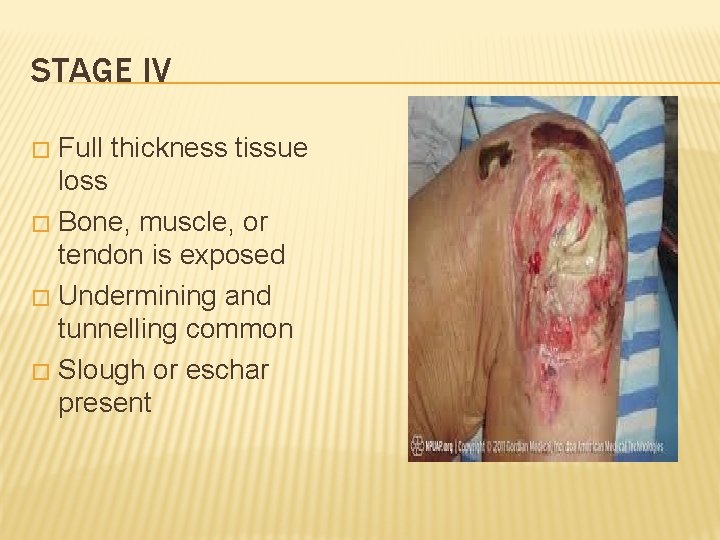 STAGE IV Full thickness tissue loss � Bone, muscle, or tendon is exposed �