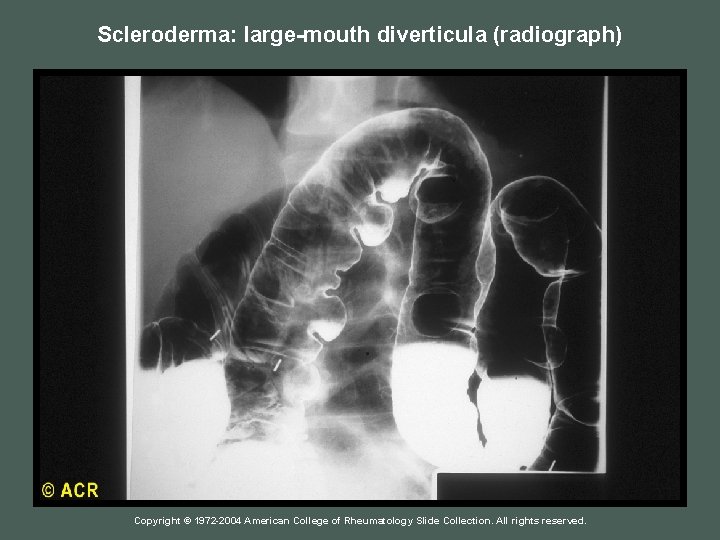 Scleroderma: large-mouth diverticula (radiograph) Copyright © 1972 -2004 American College of Rheumatology Slide Collection.