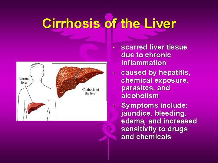 Cirrhosis of the Liver • • • scarred liver tissue due to chronic inflammation
