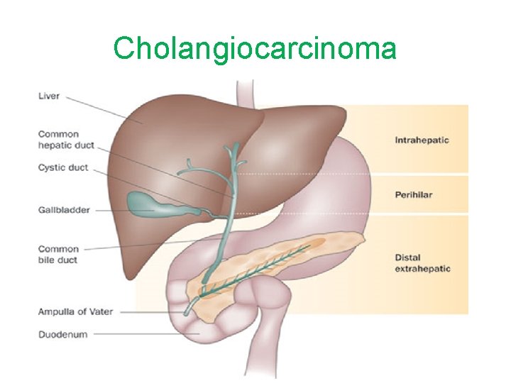 Cholangiocarcinoma 