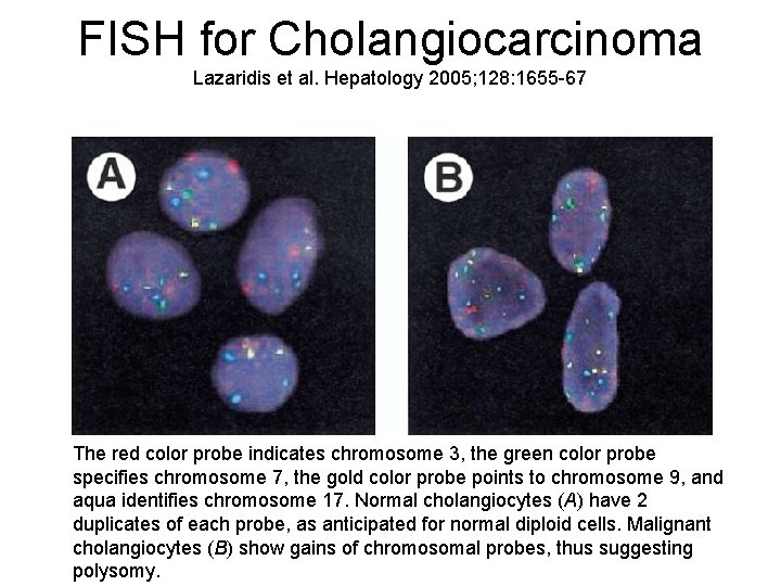 FISH for Cholangiocarcinoma Lazaridis et al. Hepatology 2005; 128: 1655 -67 The red color