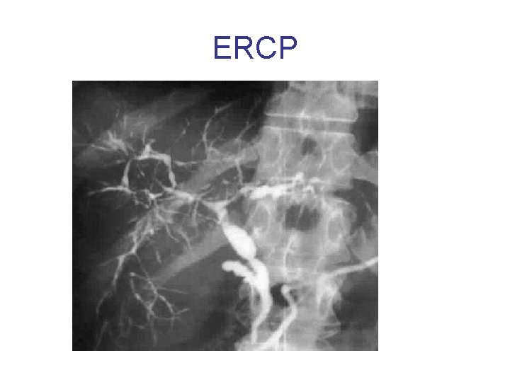 ERCP 