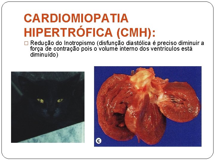 CARDIOMIOPATIA HIPERTRÓFICA (CMH): � Redução do Inotropismo (disfunção diastólica é preciso diminuir a força