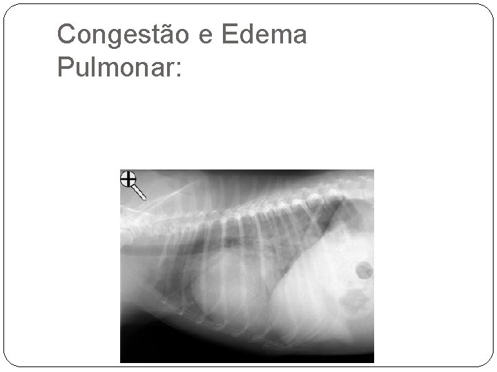 Congestão e Edema Pulmonar: 