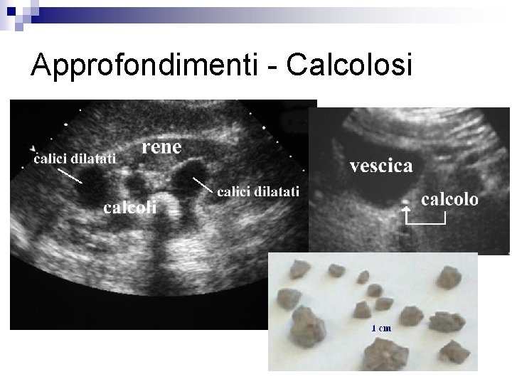 Approfondimenti - Calcolosi 