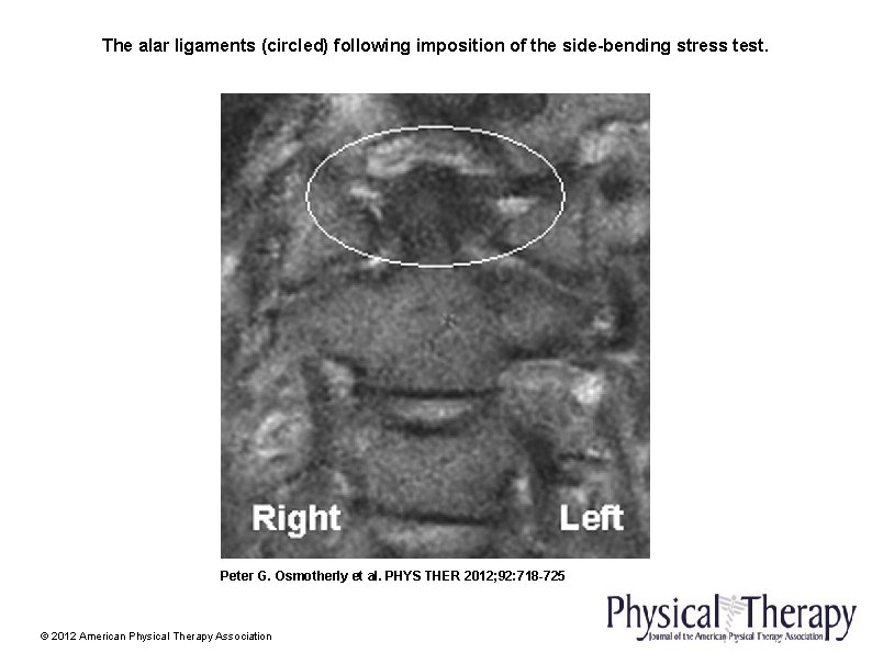 The alar ligaments (circled) following imposition of the side-bending stress test. Peter G. Osmotherly