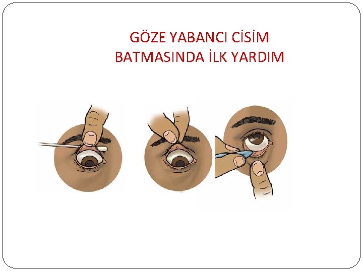 GÖZE YABANCI CİSİM BATMASINDA İLK YARDIM 