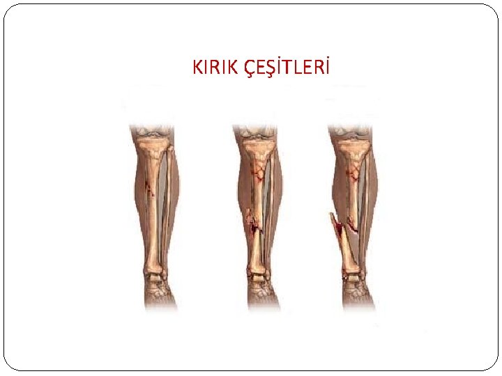 KIRIK ÇEŞİTLERİ 