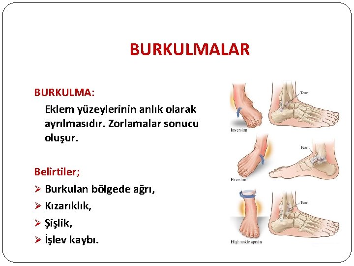 BURKULMALAR BURKULMA: Eklem yüzeylerinin anlık olarak ayrılmasıdır. Zorlamalar sonucu oluşur. Belirtiler; Ø Burkulan bölgede