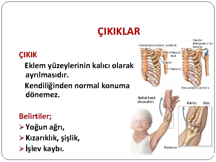 ÇIKIKLAR ÇIKIK Eklem yüzeylerinin kalıcı olarak ayrılmasıdır. Kendiliğinden normal konuma dönemez. Belirtiler; Ø Yoğun